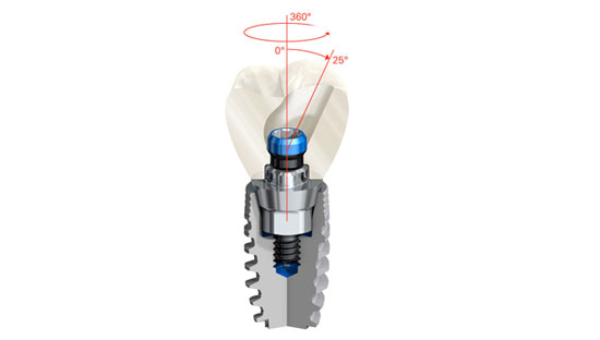 Implant mieux que dent ?